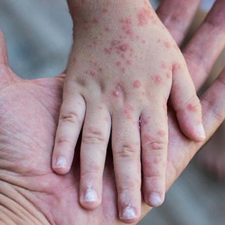 Қызылша - ауруы жайлы не білу керек?