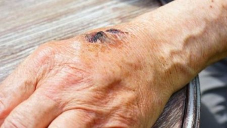 Сібір жарасы – адамдар мен жануарларға ортақ, жұқпалы аса қауіпті, зооноздық ауру