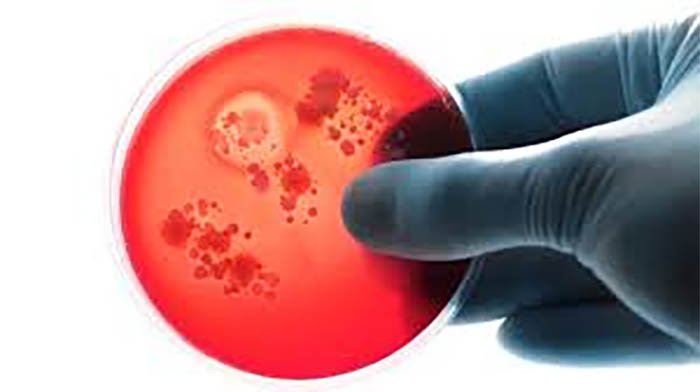 Менингококты инфекциясы – Neisseria meningitides бактерия тудыратын жіті жұқпалы ауру