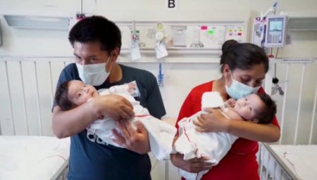 Перу дәрігерлері сиам егіздерін ажыратты