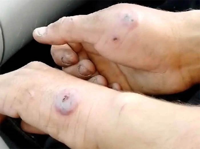 Сібір жарасы ауруының алдын алу жолдары